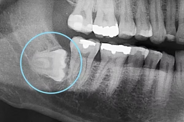 Dents de sagesse