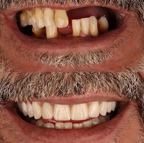 Implants dentaires